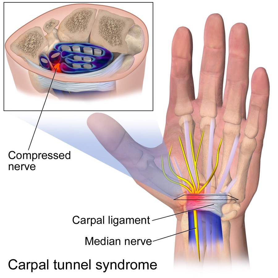 Illustration of carpal tunnel syndrome: the median nerve passing beneath the carpal ligament at the wrist, with an inset showing the nerve compressed inside the carpal tunnel.